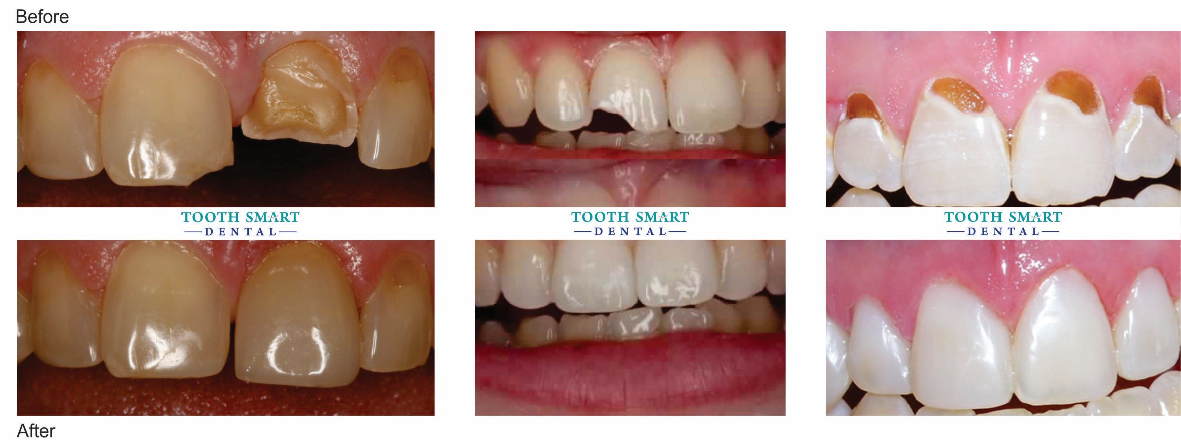 Front-Teeth-Fillings
