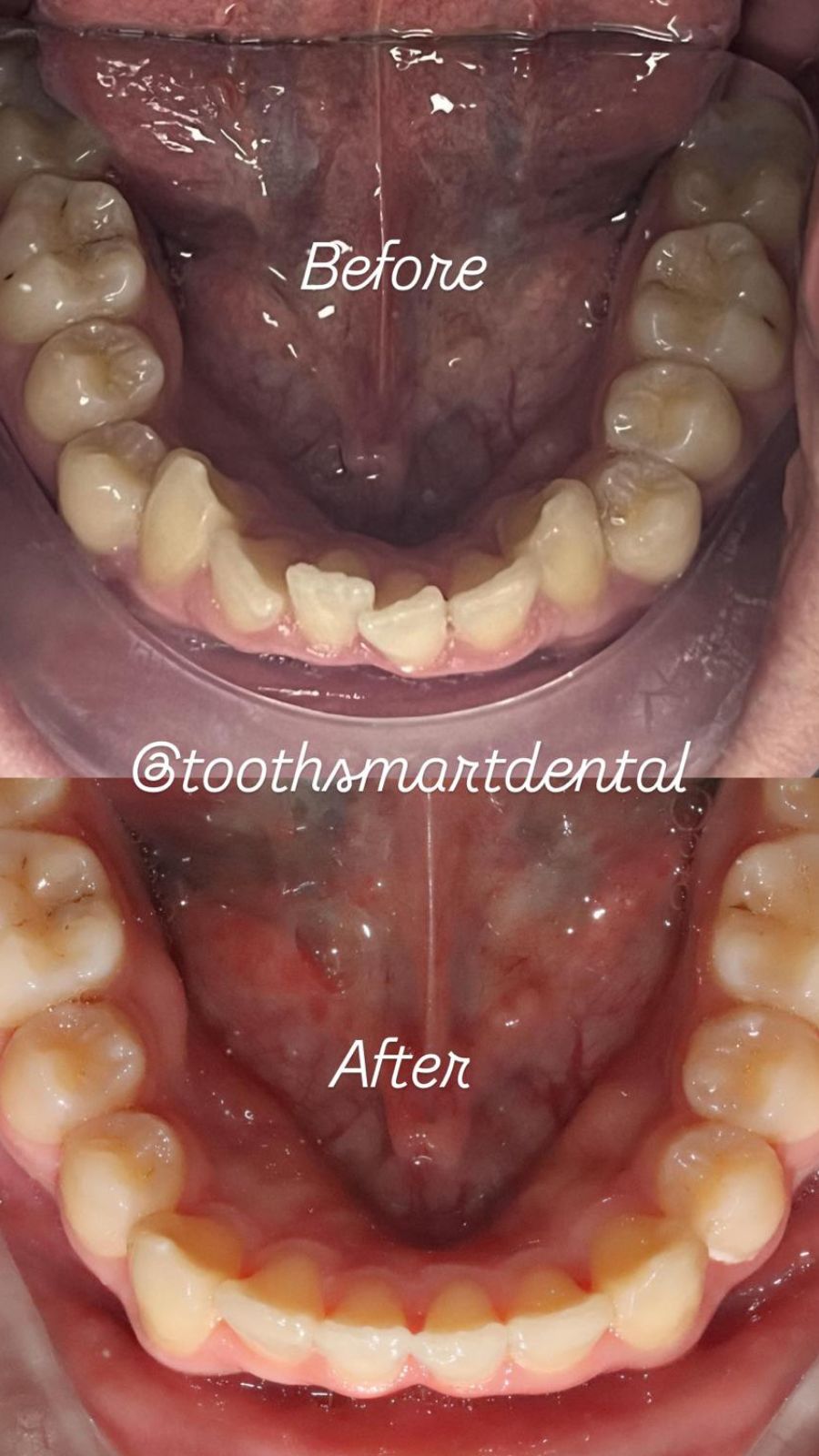 Teeth Whitening Result 3