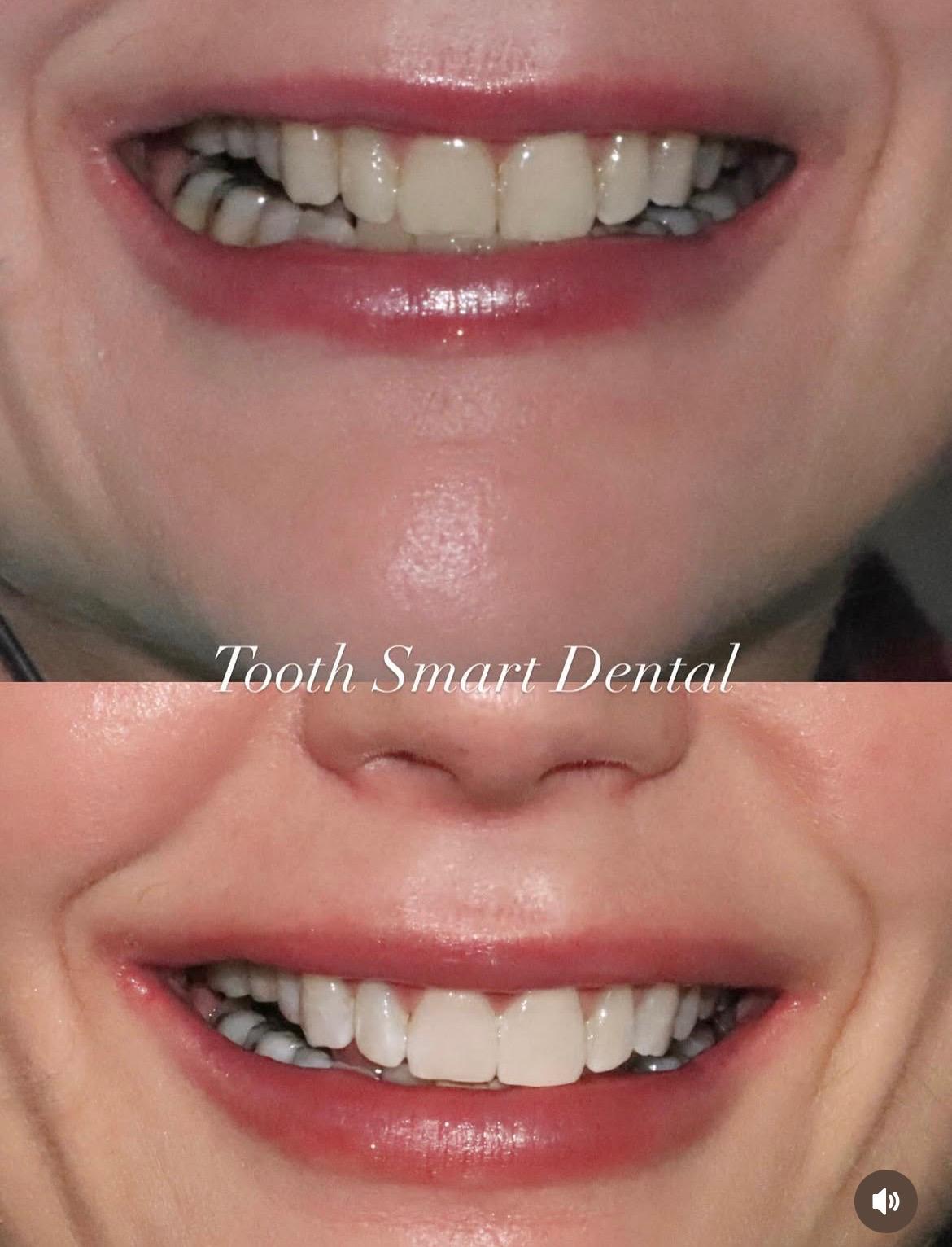 Teeth Whitening Result 4